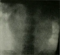 An illustration from X-rays, how to produce and interpret them (1915)