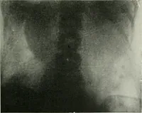 An illustration from X-rays, how to produce and interpret them (1915)