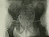 An illustration from X-rays, how to produce and interpret them (1915)