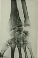 An illustration from X-rays, how to produce and interpret them (1915)