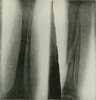 An illustration from X-rays, how to produce and interpret them (1915)