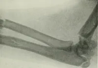 An illustration from X-rays, how to produce and interpret them (1915)