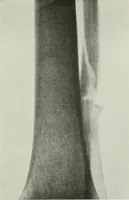 An illustration from X-rays, how to produce and interpret them (1915)