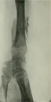 An illustration from X-rays, how to produce and interpret them (1915)
