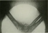 An illustration from X-rays, how to produce and interpret them (1915)