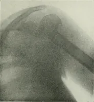 Picture 58 of 76 from X-rays, how to produce and interpret them (1915), leaf 184