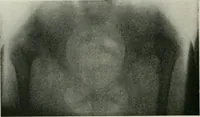 An illustration from X-rays, how to produce and interpret them (1915)
