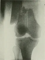An illustration from X-rays, how to produce and interpret them (1915)