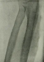 An illustration from X-rays, how to produce and interpret them (1915)