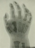 An illustration from X-rays, how to produce and interpret them (1915)
