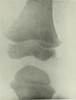 An illustration from X-rays, how to produce and interpret them (1915)