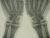 An illustration from X-rays, how to produce and interpret them (1915)
