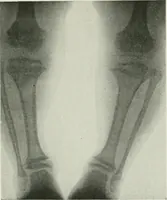 An illustration from X-rays, how to produce and interpret them (1915)