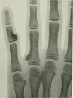 An illustration from X-rays, how to produce and interpret them (1915)