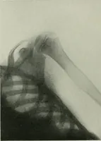 An illustration from X-rays, how to produce and interpret them (1915)