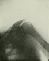 An illustration from X-rays, how to produce and interpret them (1915)