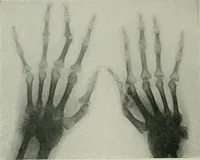 An illustration from X-rays, how to produce and interpret them (1915)