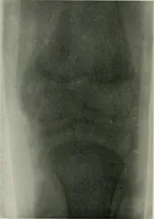 An illustration from X-rays, how to produce and interpret them (1915)