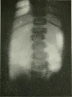 An illustration from X-rays, how to produce and interpret them (1915)