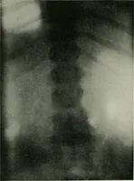 An illustration from X-rays, how to produce and interpret them (1915)