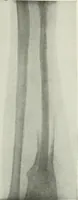 An illustration from X-rays, how to produce and interpret them (1915)