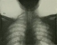 Picture 75 of 76 from X-rays, how to produce and interpret them (1915), leaf 215