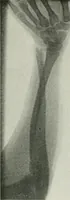 An illustration from X-rays, how to produce and interpret them (1915)