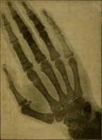 Picture 11 of 14 from X-rays simply explained : a handbook on the theory and practice of radiography (1903), leaf 90