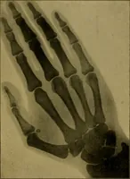 Picture 11 of 16 from X-rays simply explained : a handbook on Röntgen rays in theory and practice (1904), leaf 100