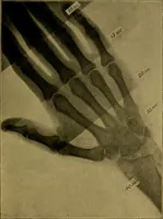 An illustration from X-rays simply explained : a handbook on Röntgen rays in theory and practice (1904)
