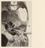 An illustration from Zur anthropologie des abflusslosen rumpfschollenlandes im nordöstlichen Deutsch-Ostrafrika, auf grund der sammlung der Ostrafrika- expedition (dr. E. Obst) der Geographischen gesellschaft in Hamburg (1915)