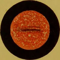 An illustration from Chronic urethritis and other affections of the genito-urinary organs : three lectures deivered at the Royal College of Surgeons in June 1889 / by Matthew Berkeley Hill. (1890)