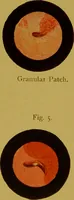 Picture 2 of 4 from Chronic urethritis and other affections of the genito-urinary organs : three lectures deivered at the Royal College of Surgeons in June 1889 / by Matthew Berkeley Hill. (1890), leaf 13