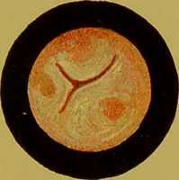 An illustration from Chronic urethritis and other affections of the genito-urinary organs : three lectures deivered at the Royal College of Surgeons in June 1889 / by Matthew Berkeley Hill. (1890)