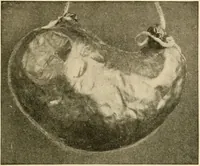 An illustration from Pediatrics : the hygienic and medical treatment of children / by Thomas Morgan Rotch. (1898)
