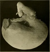 An illustration from Pediatrics : the hygienic and medical treatment of children / by Thomas Morgan Rotch. (1898)