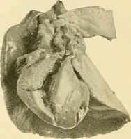 Picture 176 of 203 from Pediatrics : the hygienic and medical treatment of children / by Thomas Morgan Rotch. (1898), leaf 1104