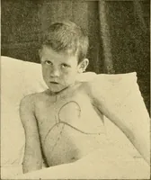 An illustration from Pediatrics : the hygienic and medical treatment of children / by Thomas Morgan Rotch. (1898)