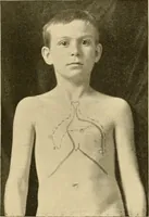 An illustration from Pediatrics : the hygienic and medical treatment of children / by Thomas Morgan Rotch. (1898)
