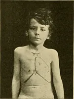 An illustration from Pediatrics : the hygienic and medical treatment of children / by Thomas Morgan Rotch. (1898)