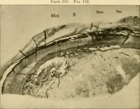 An illustration from Pediatrics : the hygienic and medical treatment of children / by Thomas Morgan Rotch. (1898)
