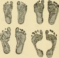 An illustration from Pediatrics : the hygienic and medical treatment of children / by Thomas Morgan Rotch. (1898)