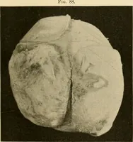 An illustration from Pediatrics : the hygienic and medical treatment of children / by Thomas Morgan Rotch. (1898)