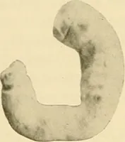 An illustration from Pediatrics : the hygienic and medical treatment of children / by Thomas Morgan Rotch. (1898)