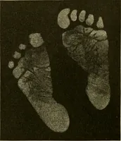 Picture 6 of 203 from Pediatrics : the hygienic and medical treatment of children / by Thomas Morgan Rotch. (1898), leaf 60