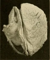 Picture 109 of 203 from Pediatrics : the hygienic and medical treatment of children / by Thomas Morgan Rotch. (1898), leaf 691