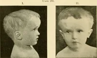 An illustration from Pediatrics : the hygienic and medical treatment of children / by Thomas Morgan Rotch. (1898)