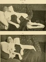 An illustration from Pediatrics : the hygienic and medical treatment of children / by Thomas Morgan Rotch. (1898)