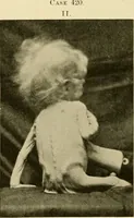 Picture 135 of 203 from Pediatrics : the hygienic and medical treatment of children / by Thomas Morgan Rotch. (1898), leaf 938