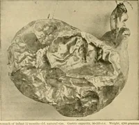 Picture 13 of 203 from Pediatrics : the hygienic and medical treatment of children / by Thomas Morgan Rotch. (1898), leaf 98